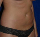 Liposuction Before and After Results in Newport Beach by Dr. Sundine