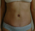 Tummy Tuck Before and After Results in Newport Beach by Dr. Sundine