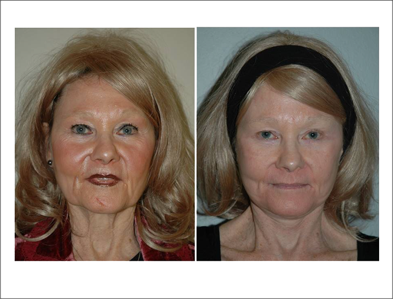 Facelift before and after photos in Newport Beach by Dr. Sundine