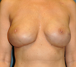 Breast Reconstruction Before and After Results in Newport Beach by Dr. Sundine