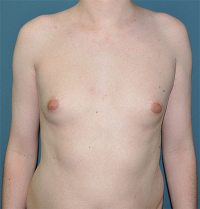 Gynecomastia Before and After Results in Newport Beach by Dr. Sundine