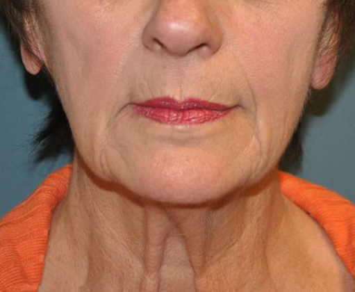 Neck Lift Before Results in Newport Beach by Dr. Sundine