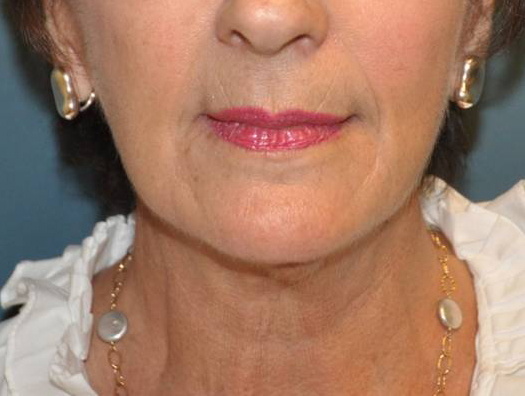 Neck Lift After Results in Newport Beach by Dr. Sundine