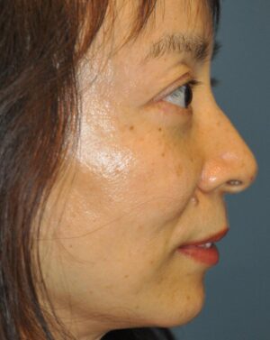 Brow Lift Before and After Results in Newport Beach by Dr. Sundine