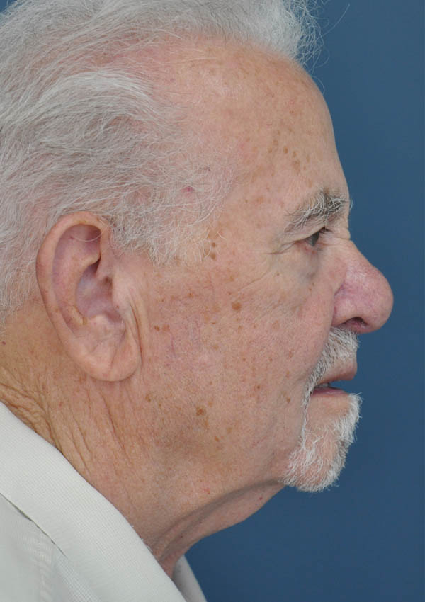 Facelift